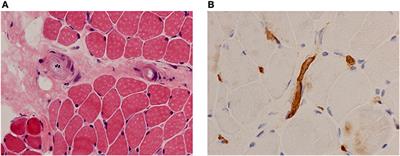 Frontiers The Vasculopathy Of Juvenile Dermatomyositis